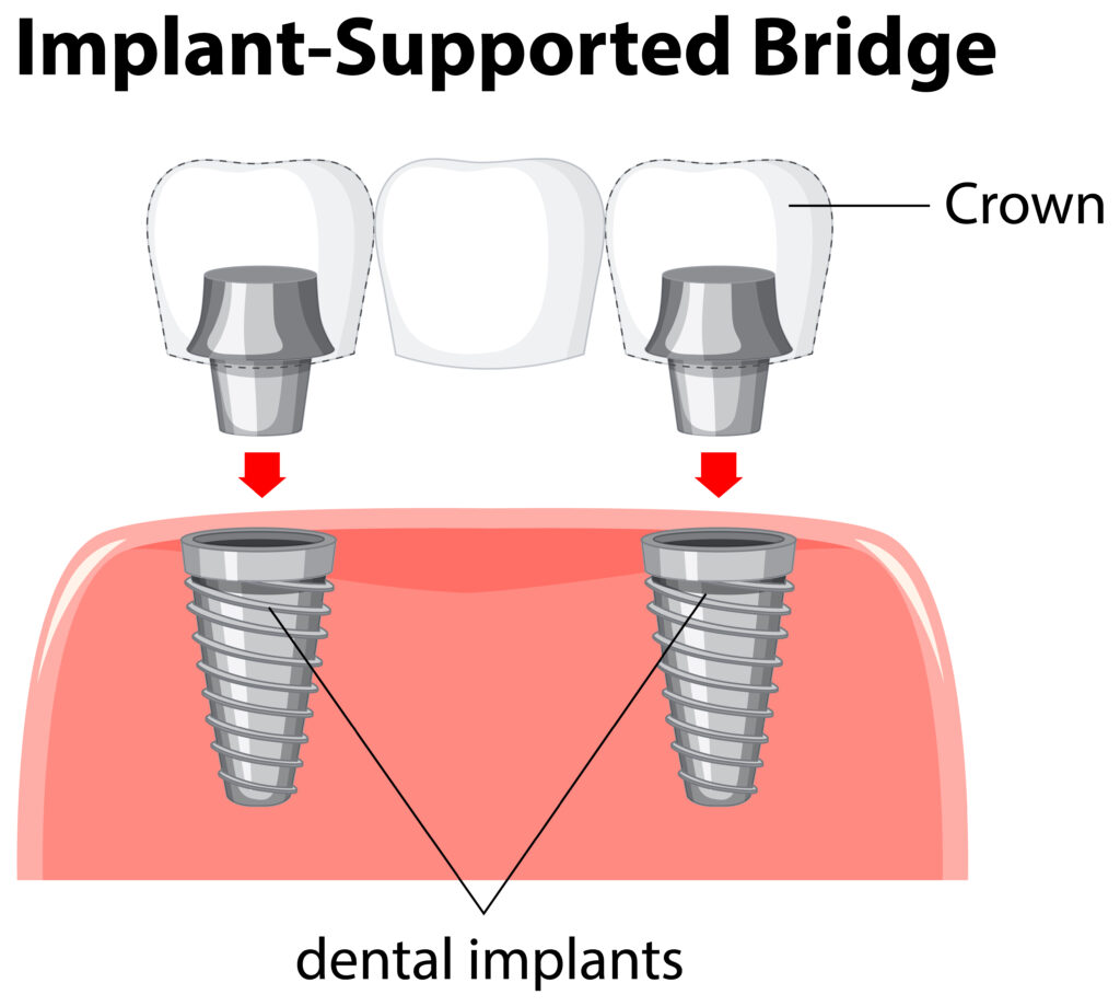 Implant-Supported Bridge: A Complete Guide to Dental Implants
